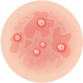 pustular psoriasis