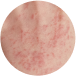 pediatric dermatology