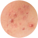 pediatric dermatology