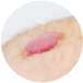 pediatric dermatology