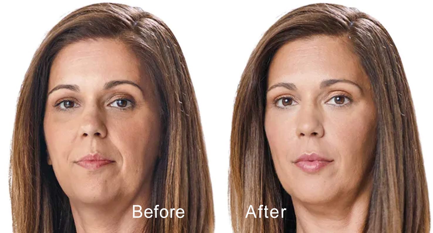 Dermal filler