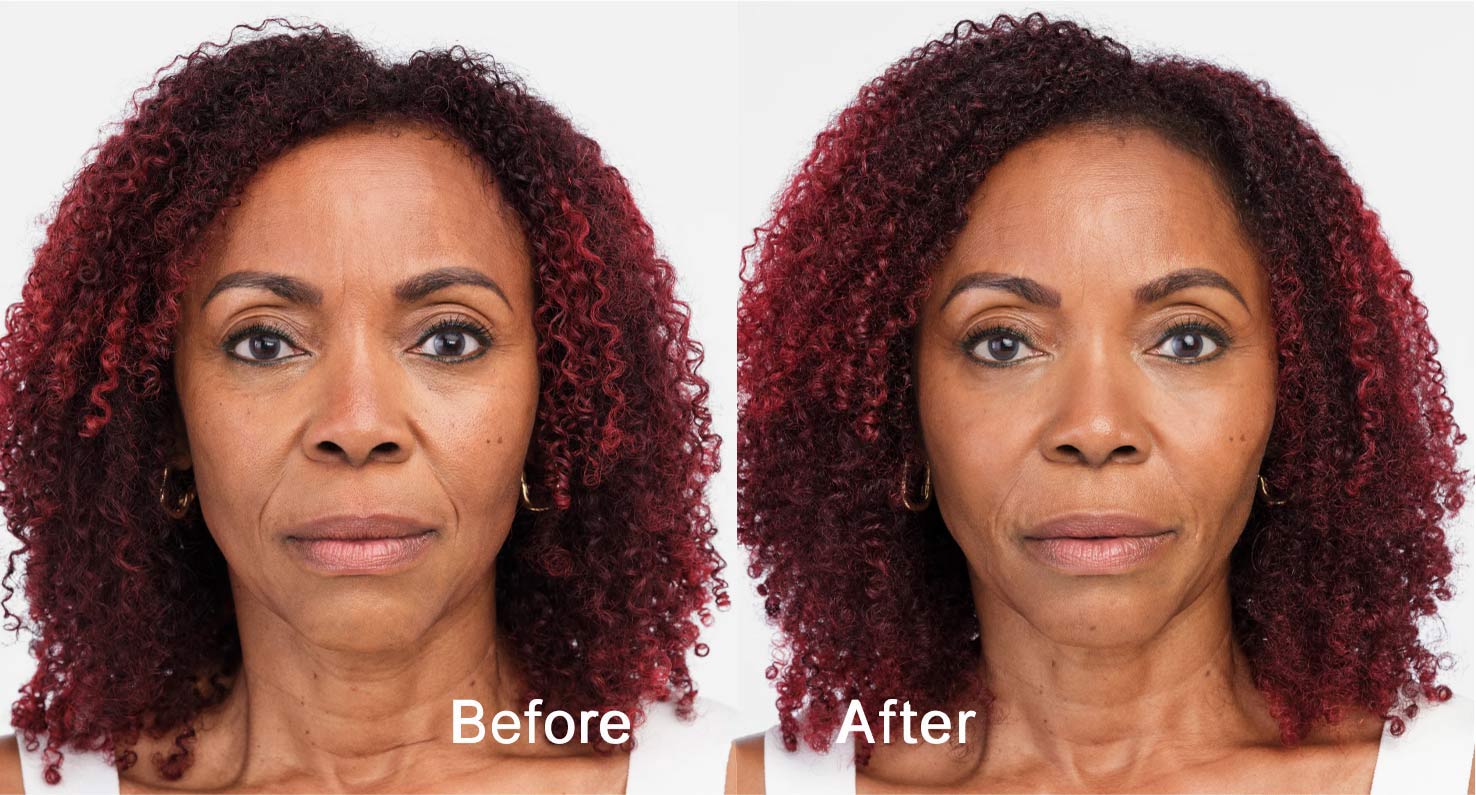 Dermal filler