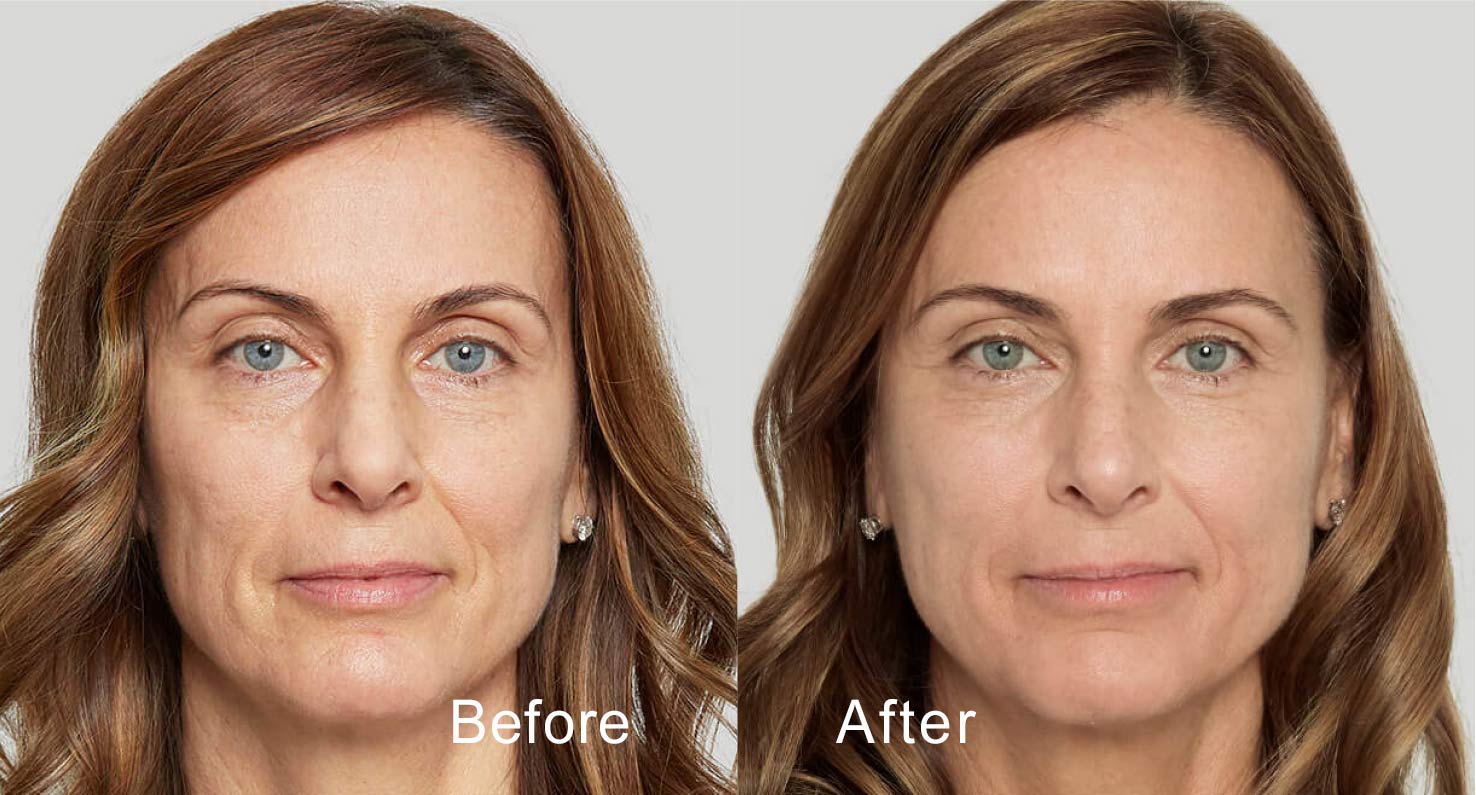Dermal filler