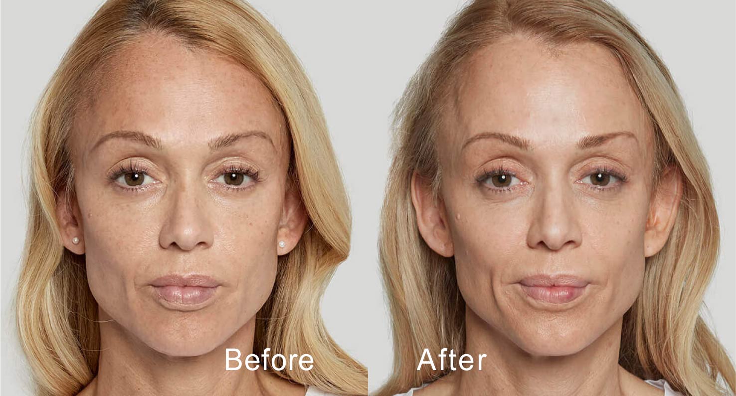 Dermal filler