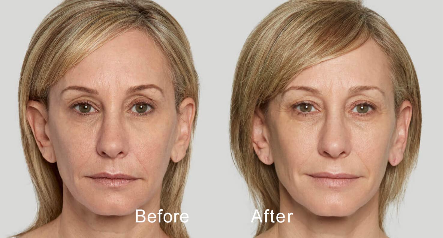 Dermal filler