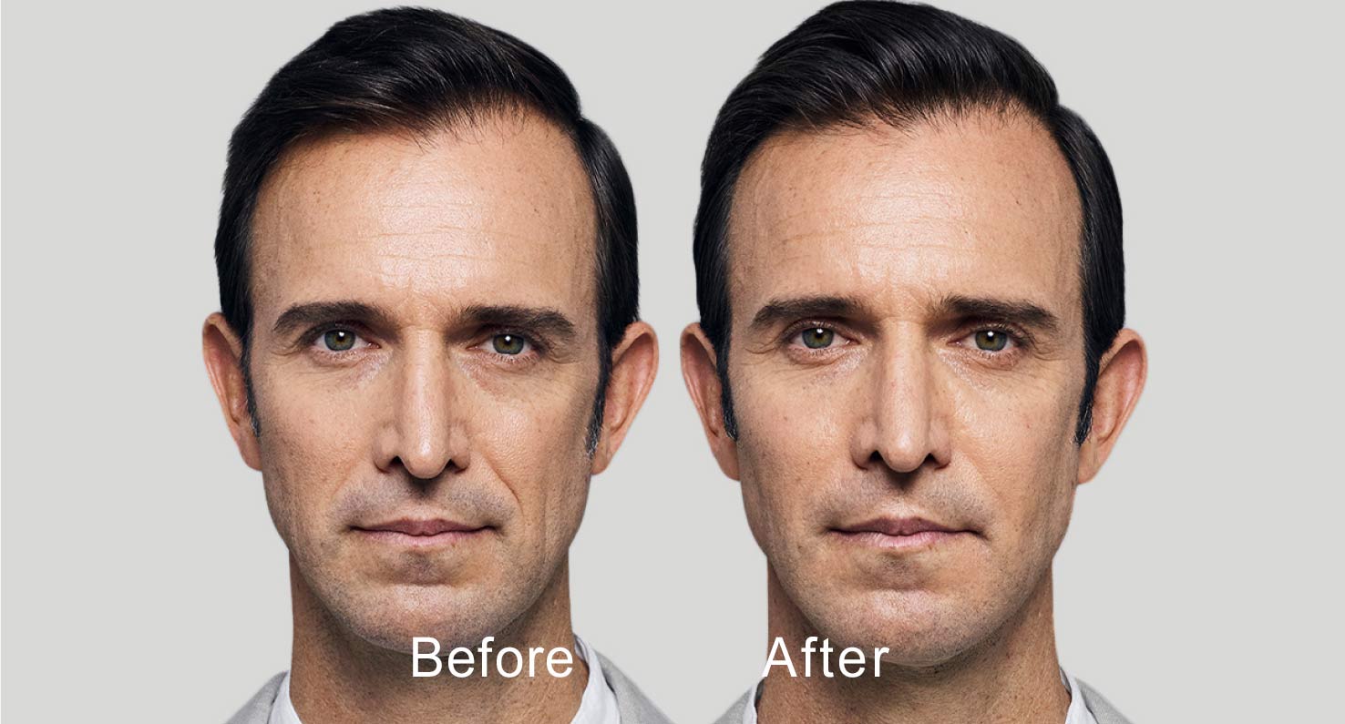Dermal filler