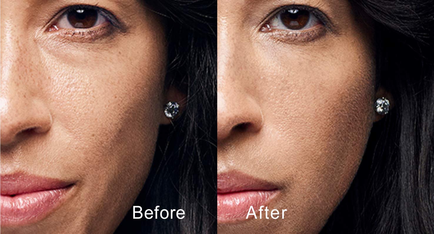 Dermal filler