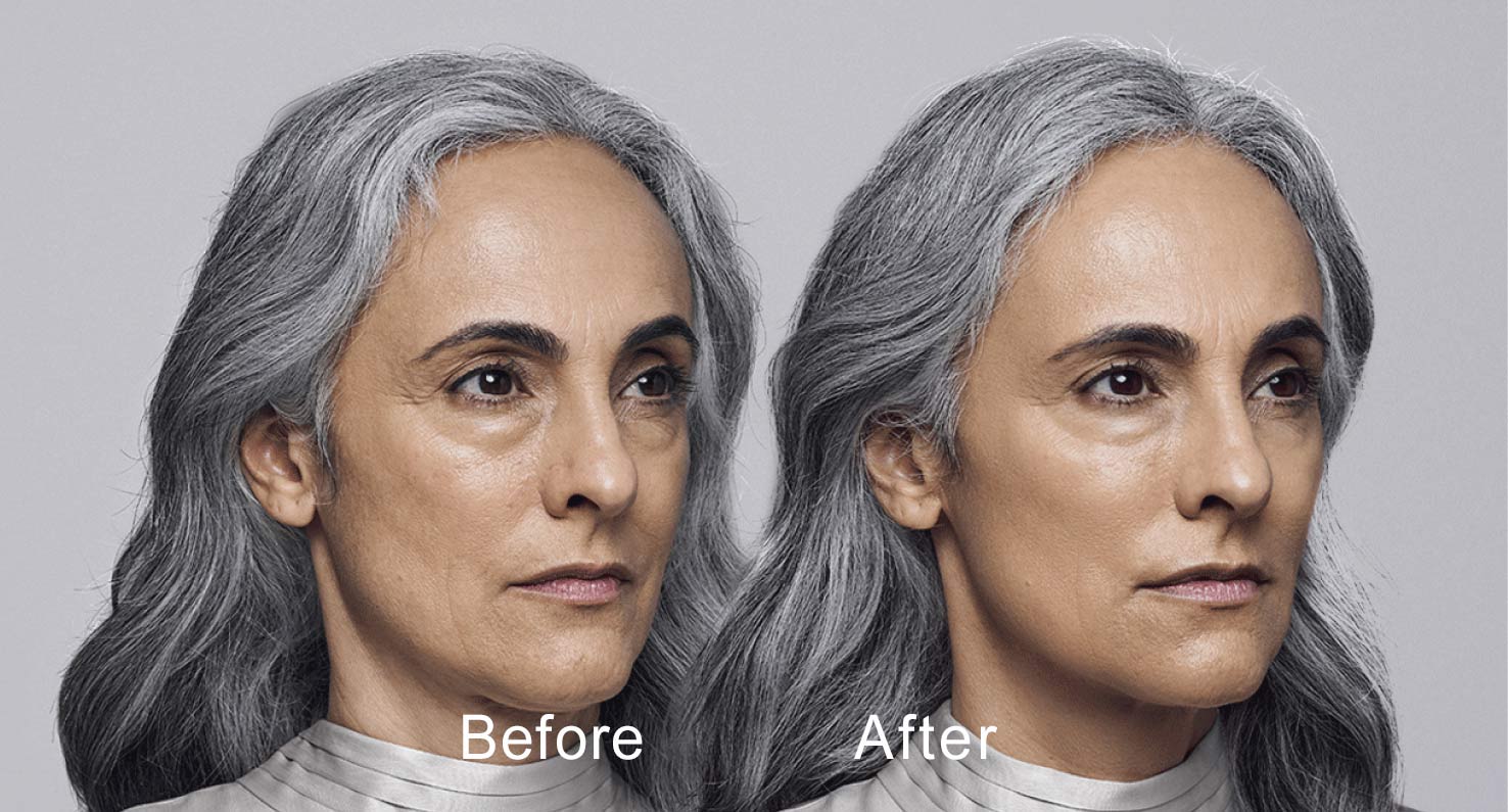 Dermal filler