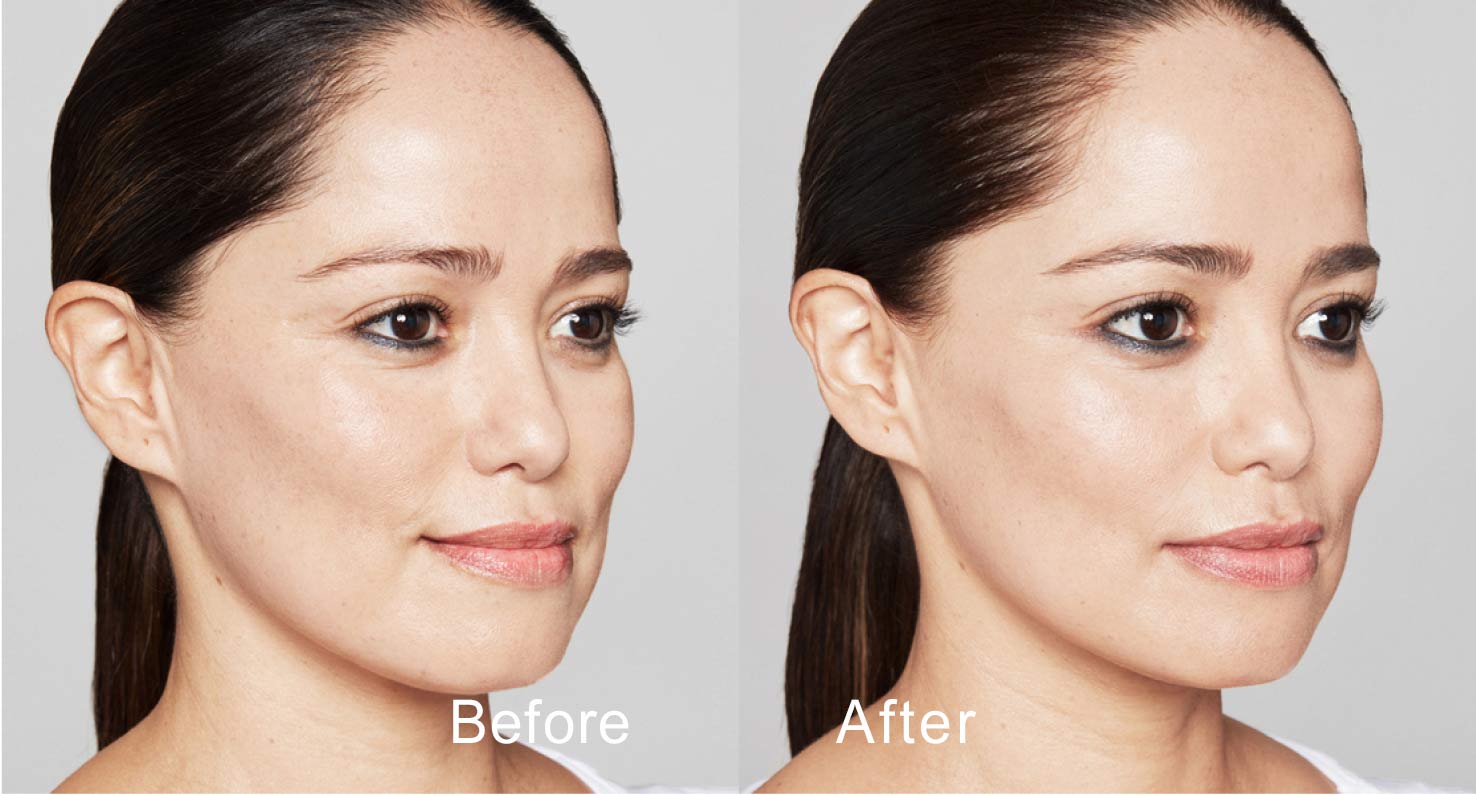 Dermal filler