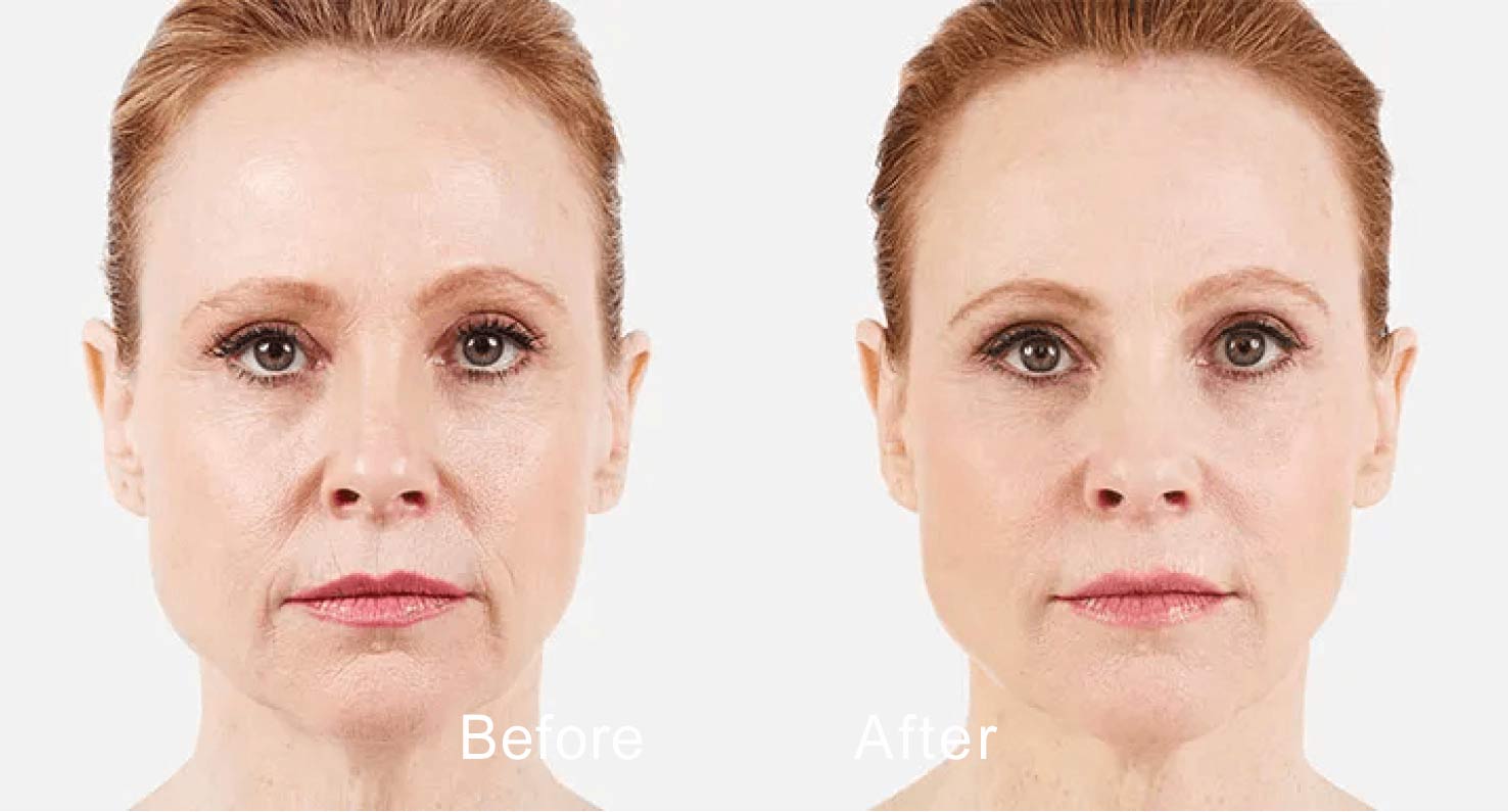 Dermal filler