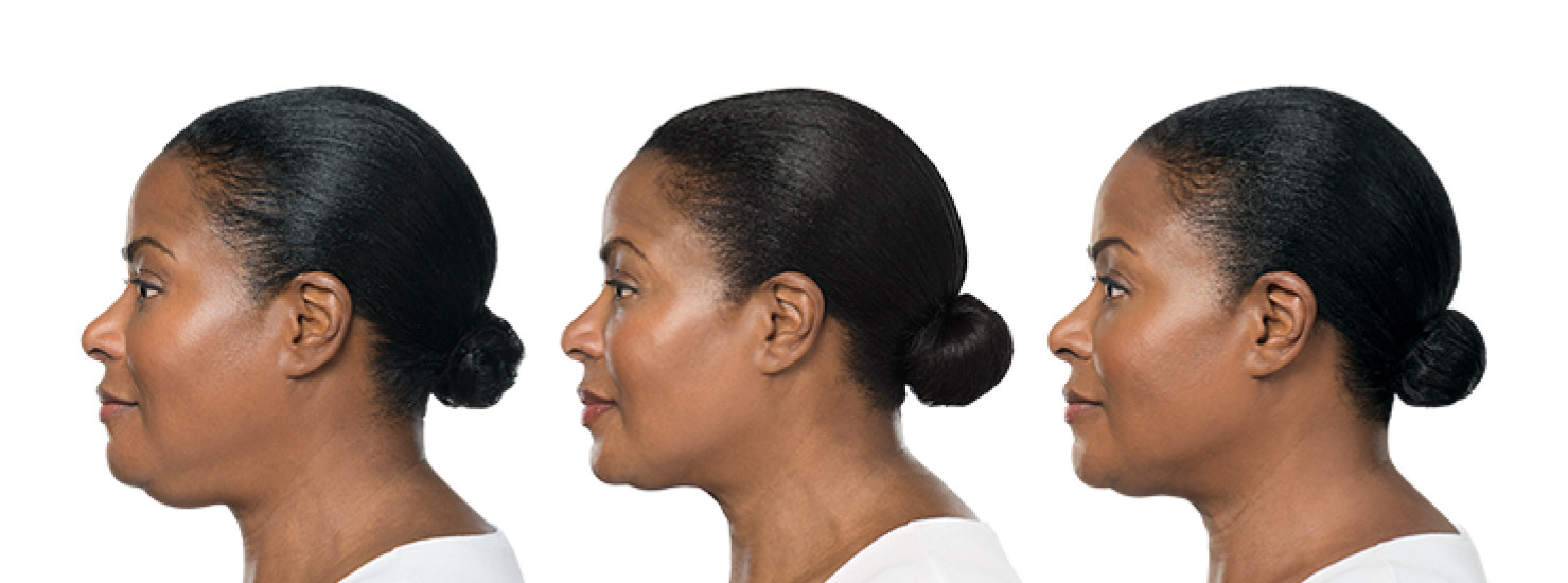 KYBELLA