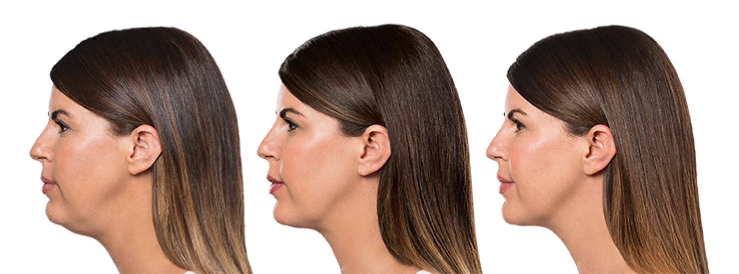 KYBELLA