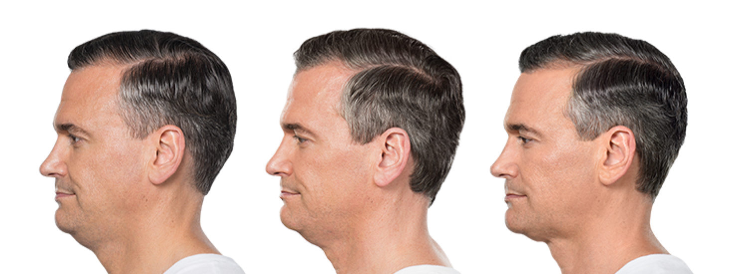 KYBELLA